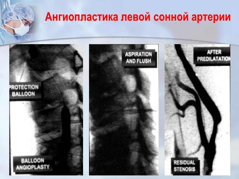 Ангиопластика левой сонной артерии